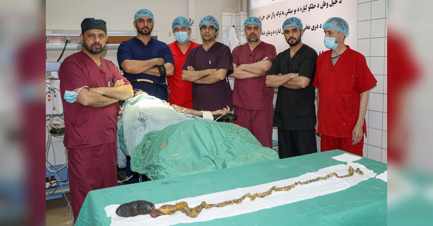 Successful surgical removal of a large Hair mass from the stomach and Intestines of a woman in Kabul.
